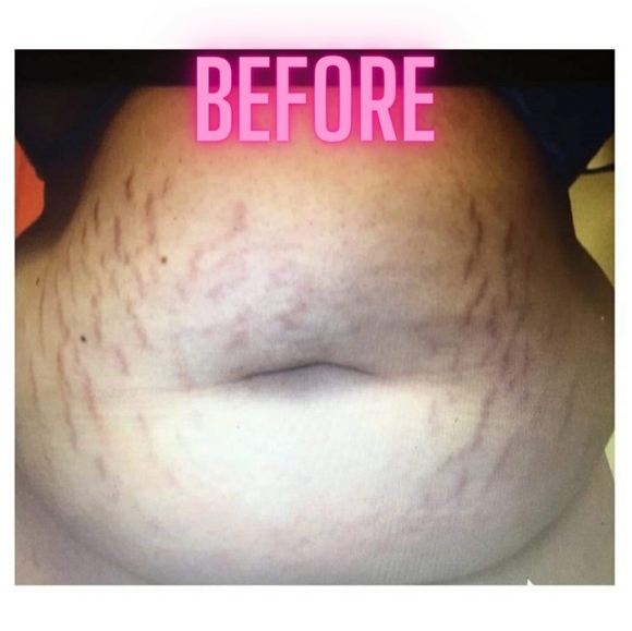 PREORDER ONLY ByeBye Stretch Marks,Mosquitos,Burns - Picture 3 of 16